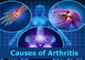 Causes of Arthritis